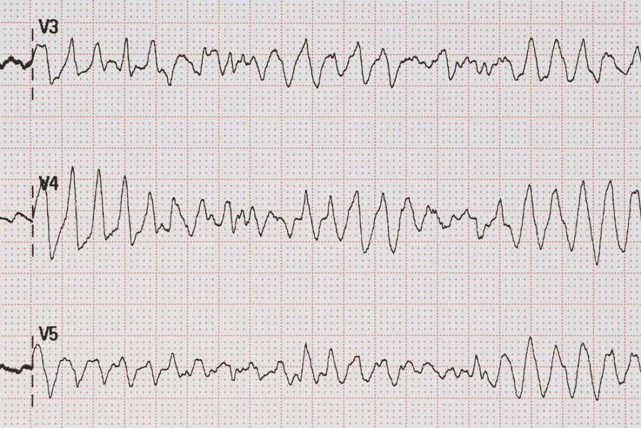 fibrillazione ventricolare torsione di punta