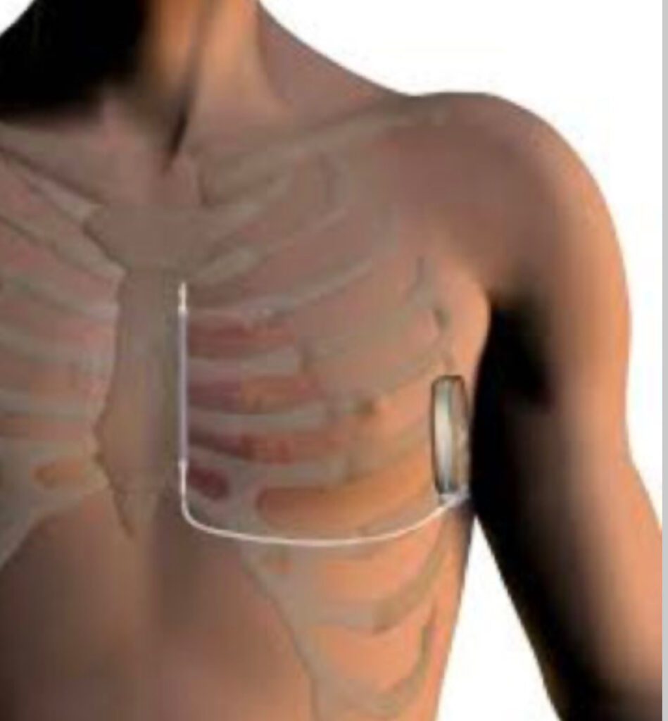 Un esempio di impianto di defibrillatore sottocutaneo