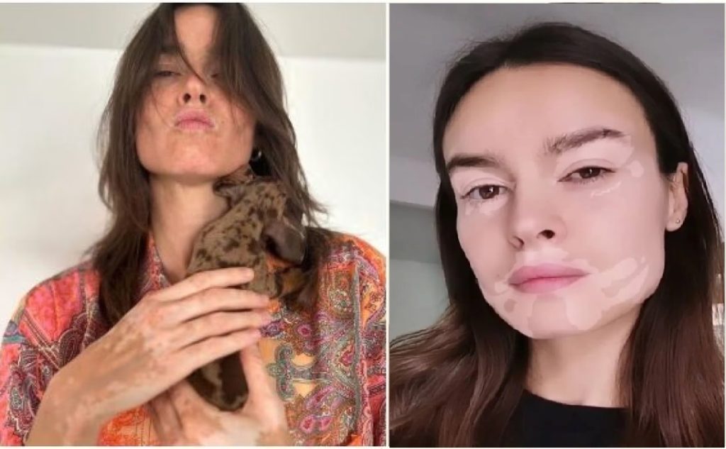 Kasia Smutniak (45) ha lanciato qualche tempo fa un filtro di bellezza e un hashtag, #beautyligo, che fa vedere a tutti come sarebbero con la vitiligine.