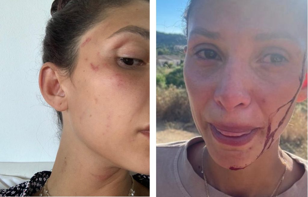 Gli scatti che documentano le violenze subite da Sara Bluma (30).