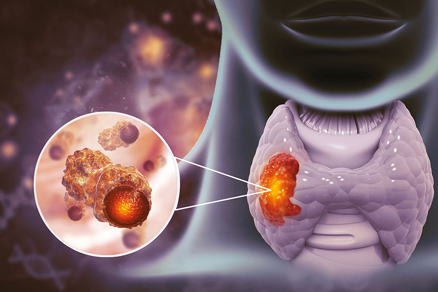 Settimana Mondiale della Tiroide, dalla prevenzione alla diagnosi precoce 2 Giornata Mondiale della Tiroide, dalla prevenzione alla diagnosi precoce