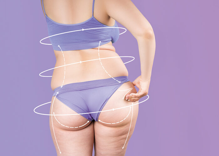 Una guida completa per contrastare la cellulite: i primi risultati in poche settimane Una guida completa per contrastare la cellulite: i primi risultati in poche settimane