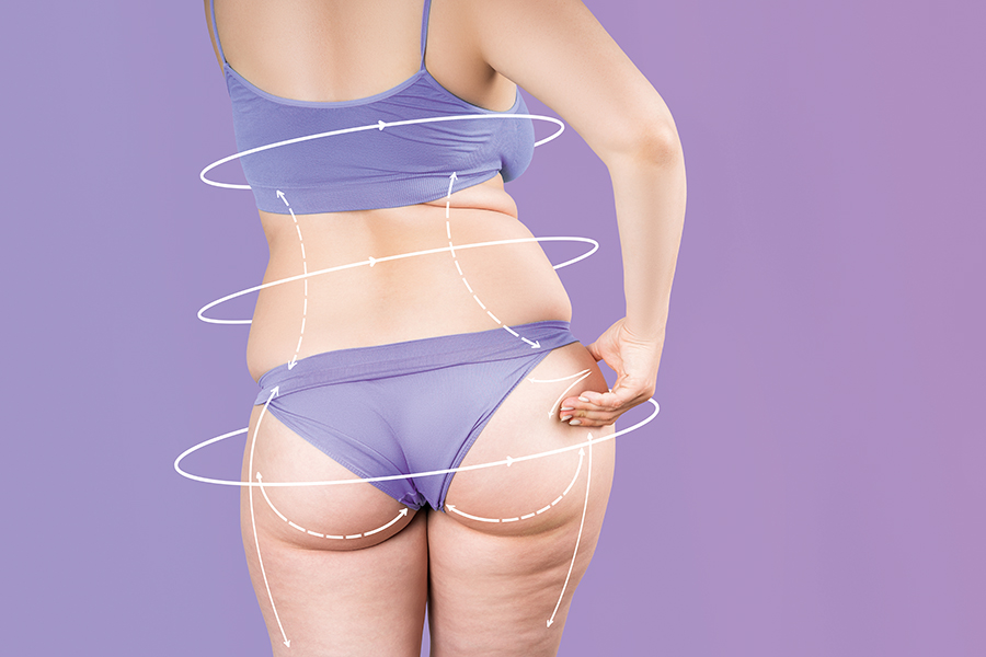 Una guida completa per contrastare la cellulite: i primi risultati in poche settimane