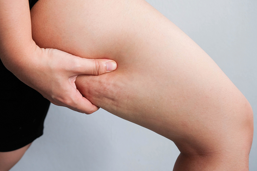 Una guida completa per contrastare la cellulite: i primi risultati in poche settimane 2 Una guida completa per contrastare la cellulite: i primi risultati in poche settimane