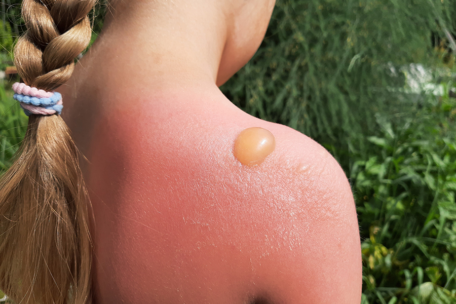 Vacanze con bambini: cosa fare in caso di annegamento, colpo di sole, meduse e altre emergenze estive